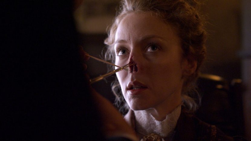 The-Knick-Nose-Replacement-2